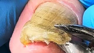 Twisted, Super Thick Toenail Fungus! (Scip-Scip-Scip) Forcefully Trimming It【Xue Yidao】