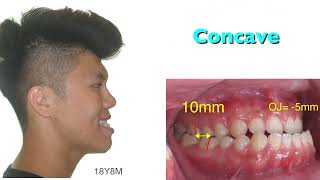 Nonsurgical  Correction of A Severe Class III Malocclusion with Miniscrews｜【Chris Chang Ortho】CC424