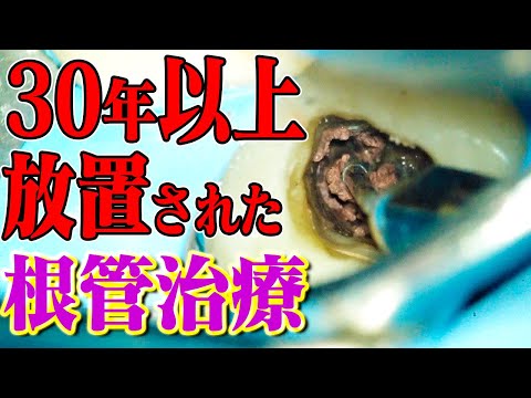 【虫歯治療 福岡】※衝撃映像！虫歯で侵された根管を福岡最大のむらつ歯科クリニックさんで治療！【サーカス改善プロジェクト外伝】