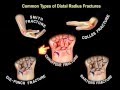 Common Types Of Distal Radius Fractures - Everything You Need To Know - Dr. Nabil Ebraheim