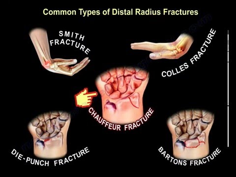 Video: Fracture Of The Wrist Joint