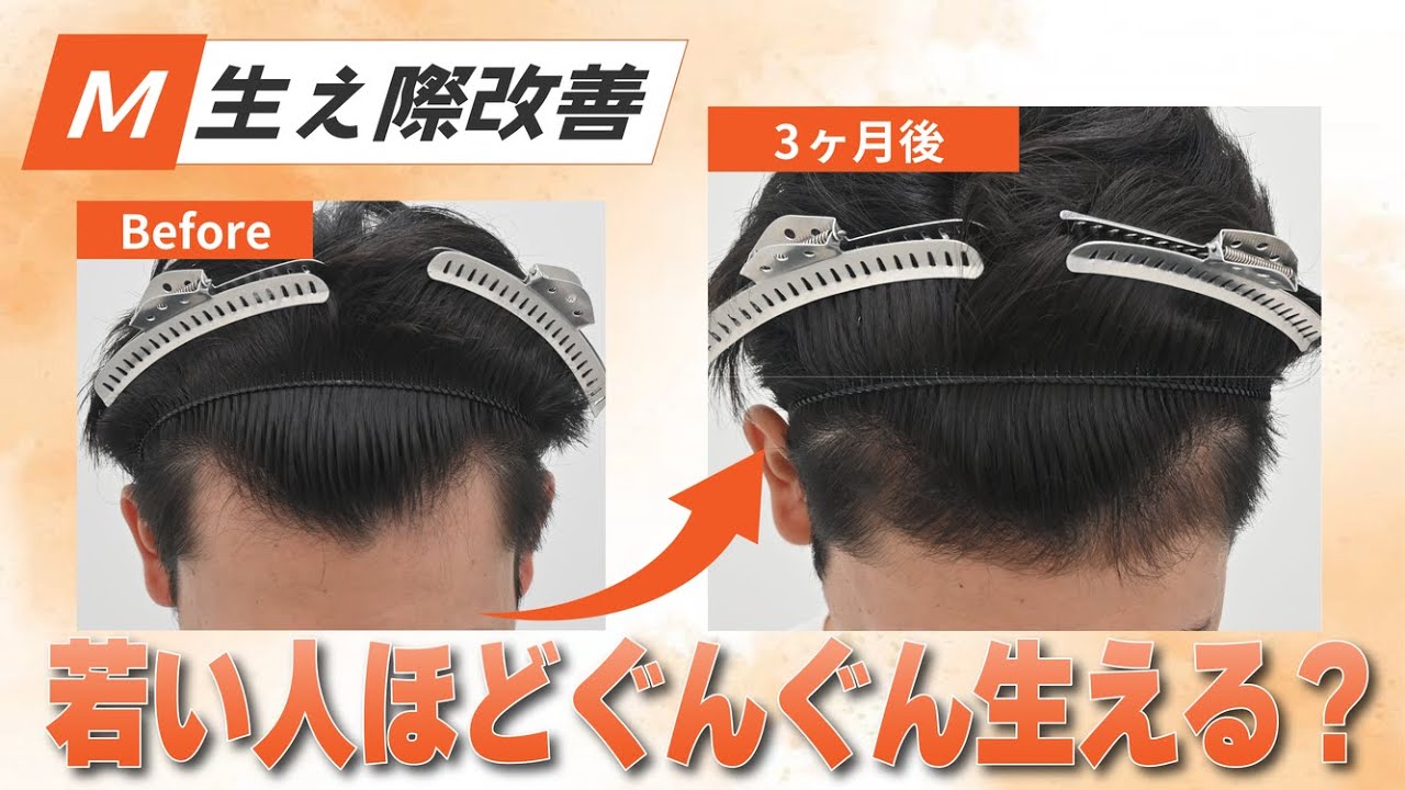毛根再生注射が凄すぎた！生え際改善ビフォーアフター公開
