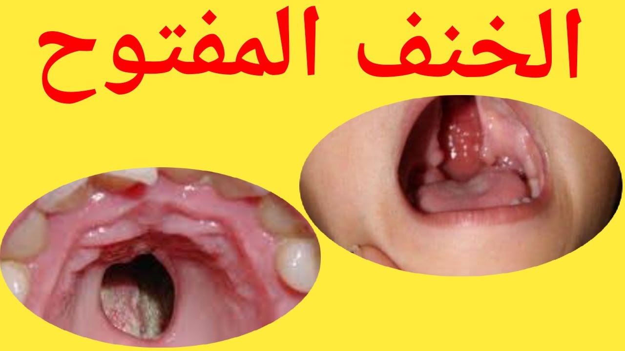 الخنف المفتوح