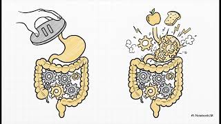 The Functional Cure for Bile Acid Malabsorption (BAM)