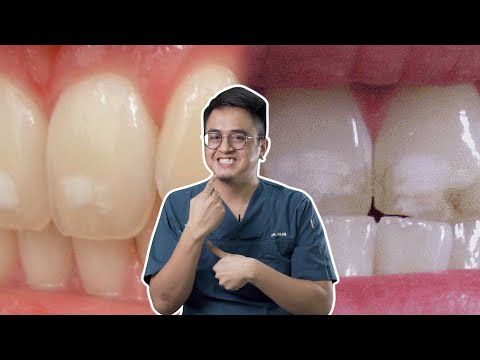 Fluorosis: Gigi Bertompok Putih