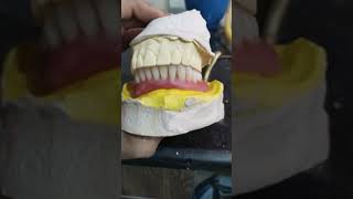 Lower Denture On Two Implants