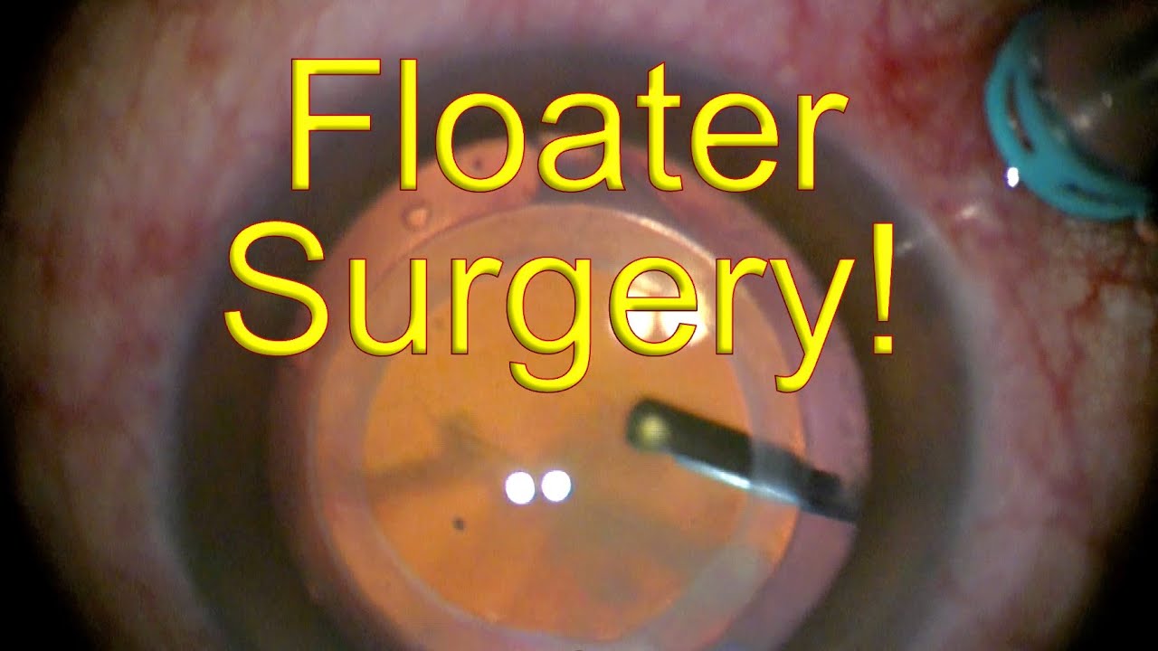 Does Vitrectomy Remove All Floaters?