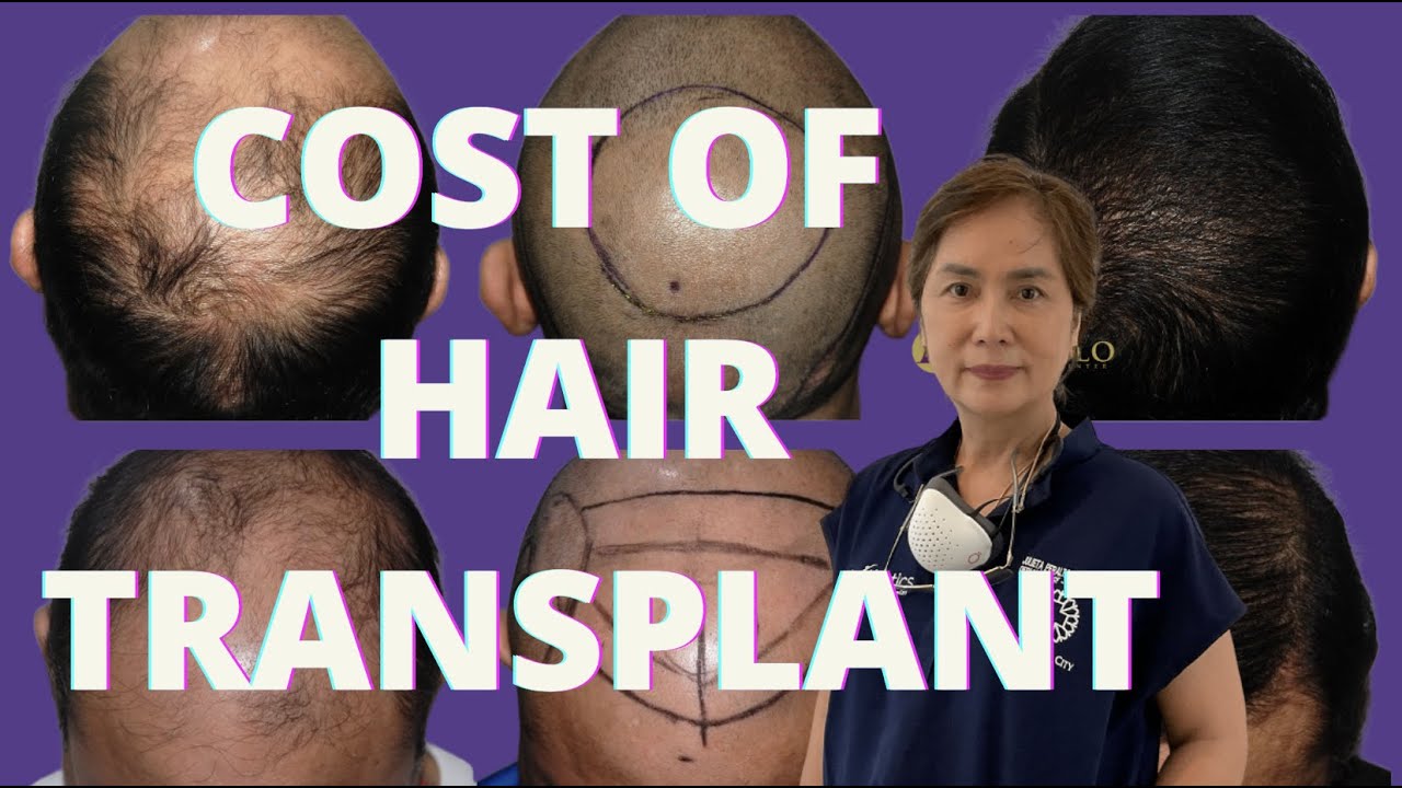 How much is hair transplant? | Teaser video by Dr. Peralta - Arambulo