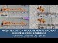 MASSIVE COTTON WOOL REMOVAL AND EAR WAX PEEL FROM EARDRUM - EP 198