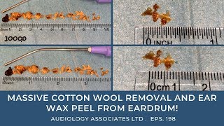 MASSIVE COTTON WOOL REMOVAL AND EAR...
