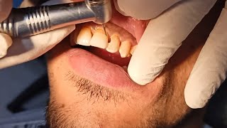 class 3 composite restoration and caries removal/filling front teeth