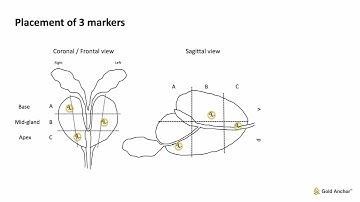 Gold Anchor fiducial marker placement