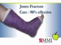 Dr. Frank Nisenfeld at MMI - Jones Foot Fracture