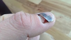 Fix a Smashed Fingernail with Baking Soda and Superglue