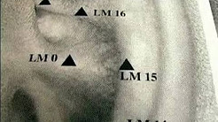 Treating Common Ailments With Acupuncture : How to Treat Drug Addiction With Acupuncture