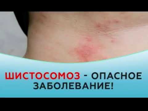 Видео: Являются ли симптомы шистосомоза?