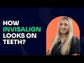 How Invisalign looks on teeth? Can you tell if someone has Invisalign?