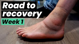 Road to Recovery  The Ankle Sprain Rehab Chronicles | week 1