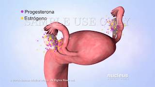 Dispositivo intrauterino (DIU)