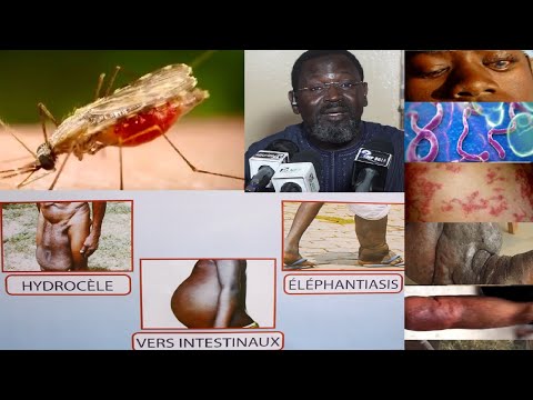 Vidéo: Fréquence Et Distribution Des Maladies Tropicales Négligées Au Mozambique: Une Revue Systématique