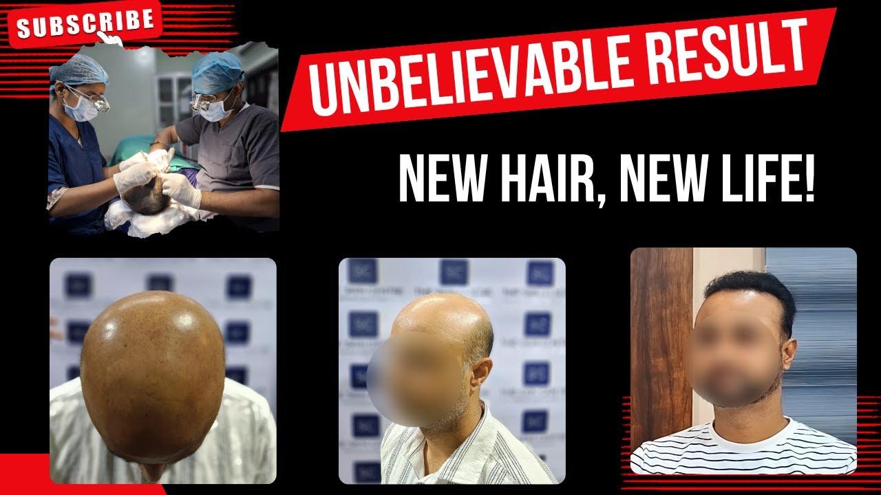 Understanding Hair Loss Treatment