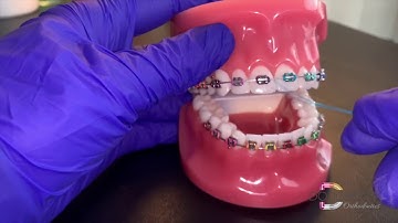 Flossing with Braces: Using a Floss Threader - Dougherty Orthodontics (St. Louis, Missouri)