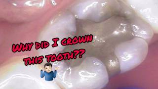 BROKEN TOOTH!? Why did I place a CROWN?