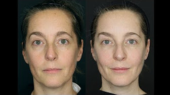 Liquid Lift Erfahrungen Unterspritzung Mit Botox Und Hyaluron Vorher Nachher Youtube