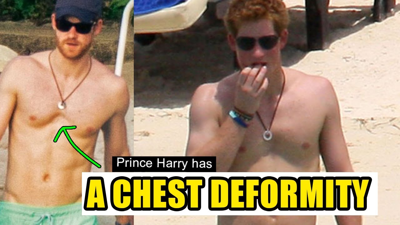 The Uncommon Chest Deformity That Prince Harry Has (PECTUS ARCUATUM!)