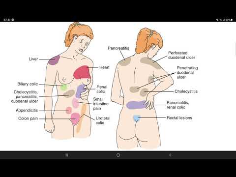 Mosbynuclex Common Sites Of Referred Pain Chapter 3part 4