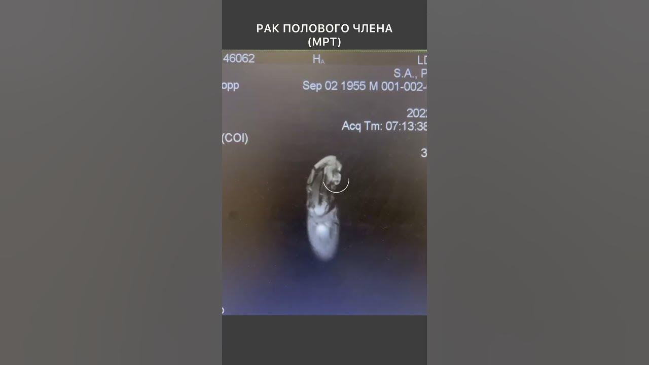 Как выглядит рак пениса