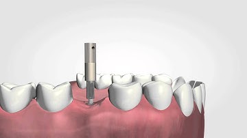 Osstell ISQ   the only objective way to measure implant stability HD