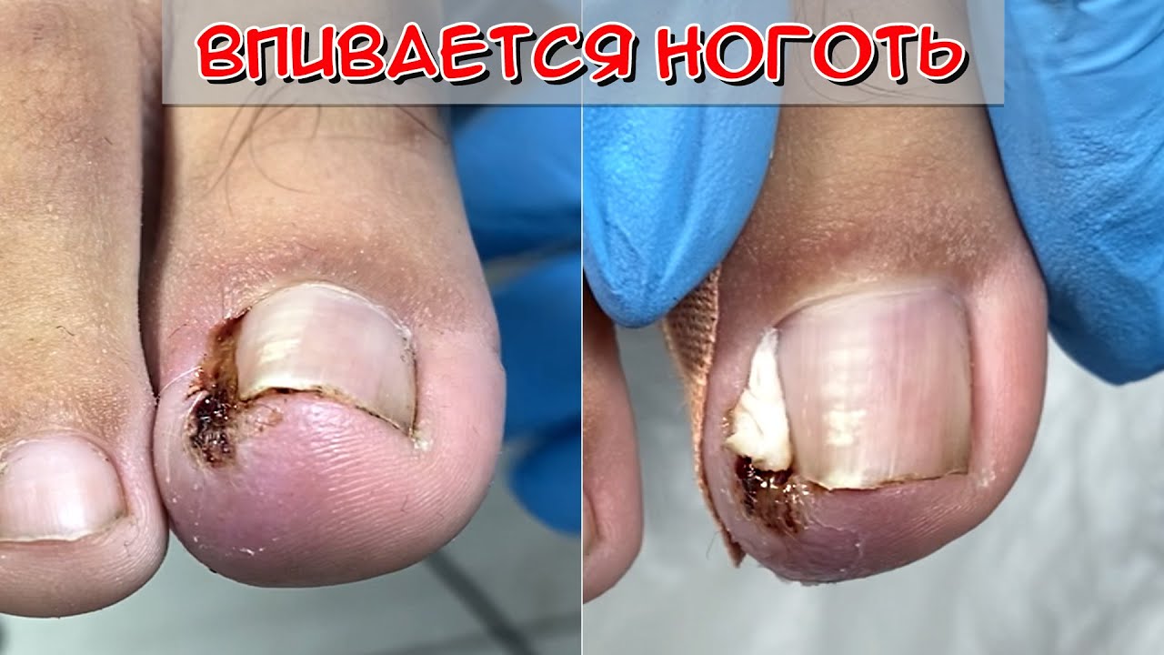 Вросший ноготь на большом пальце ноги / Влажная стопа - YouTube