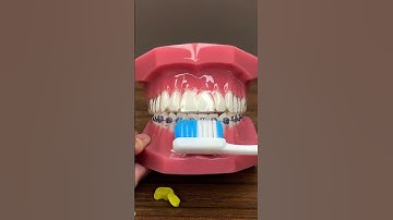 Hướng dẫn vệ sinh răng niềng bằng bản chải thường #nhakhoa #dentist #niengrang #niềngrăng