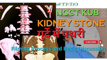 CT Scan of KUB (Non-Contrast Computed Tomography of Kidney, Ureter, and Bladder) #kub #ctscan