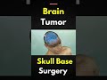 How Surgeons Remove Brain Tumors 3D Explained #BrainSurgery #Medical #Shorts