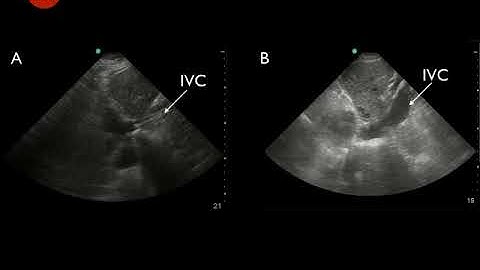 Video 10   collapsible and non collapsable IVC with respiration