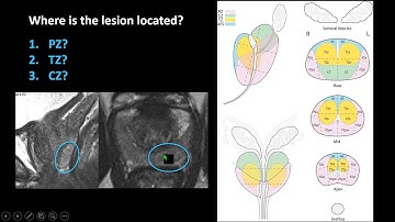 ICIS 2017: PI RADS update by Prof. Jelle Barentsz