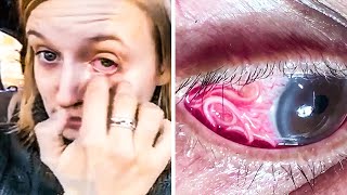 Woman Thinks ‘Eyelash’ Is In Eye, But Doctor Explains &quot;It&#39;s a Parasite&quot;