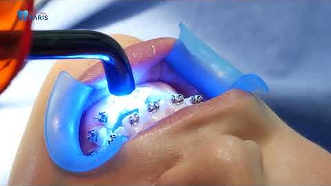 Cận cảnh quá trình gắn mắc cài kim loại khi niềng răng