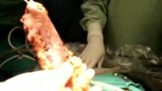 Gastrectomía subtotal video-laparoscopica