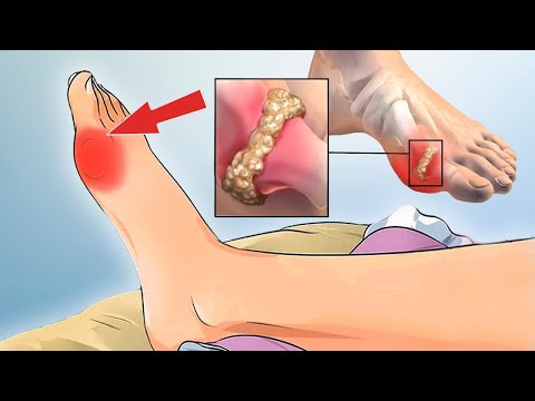 Video: Was is gewrichtskraakbeen?