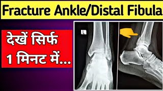 Fracture Distal Fibula | Fracture Lateral Malleolus of Fibula | X-Ray Ankle Joint | UdayXray screenshot 5