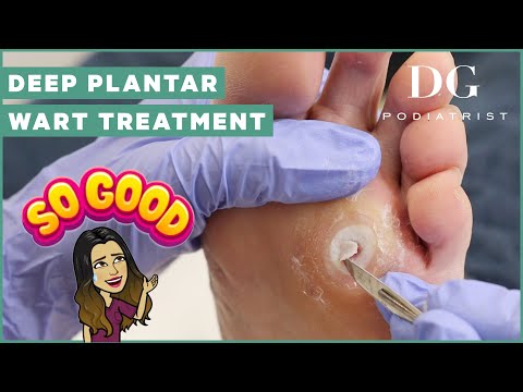 Plantar wart treatment with "7-year dressing" | The Foot Scraper: DG Podiatrist