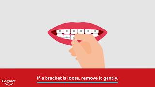 How to Fix a Broken Braces Bracket