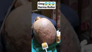 Derma Roller For Hairloss Shorts