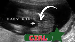 Ultrasound showing girl baby !!!