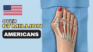 The Truth About Bunion Surgery: Is It Really Necessary? #Bunions #FootPain #BunionSurgery