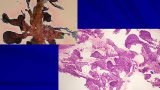 Thyroid Cytology II: Cases