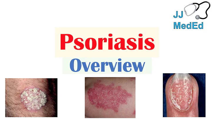 Overview of Psoriasis | What Causes It? What Makes It Worse? | Subtypes and Treatment - DayDayNews